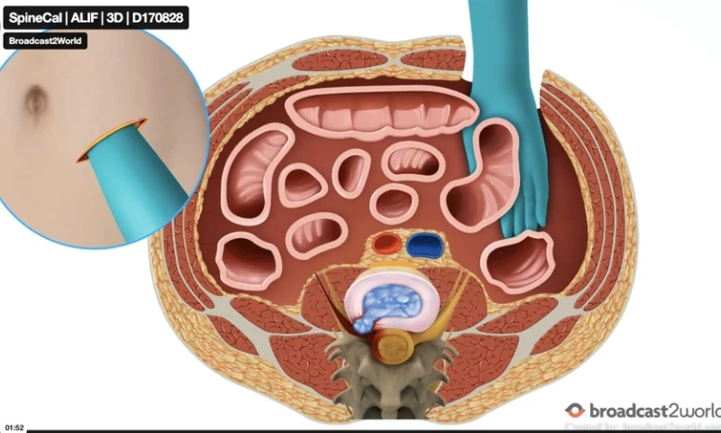 Broadcast2world - SpineCal: ALIF Spine Surgery Patient Education Animation