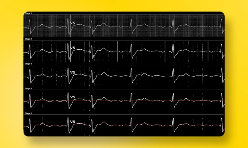 Exposit - Computer Vision System for ECG digitization