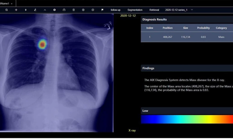 AI-Assisted Chest X-Ray Analysis