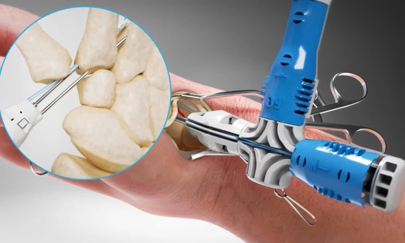 Nanobot Medical - 3D animation of surgical technique