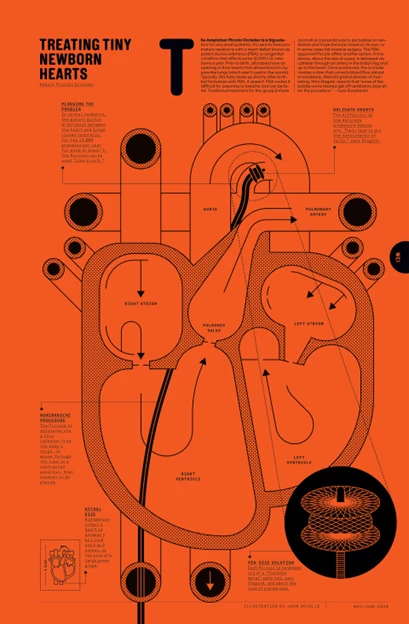 Orange and black illustration how a piccolo occluder works Healthcare Infographic